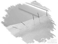 针灸（刘氏刺熨疗法）