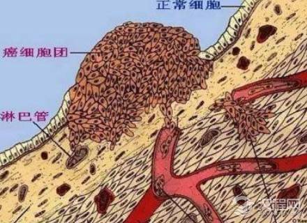 揭秘古人为什么就不得癌症 不只是运气好那么简单