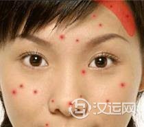 痘痘告诉你哪里生病了，脸上长痘痘怎么调理