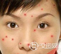 痘痘告诉你哪里生病了，脸上长痘痘怎么调理