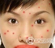 痘痘告诉你哪里生病了，脸上长痘痘怎么调理