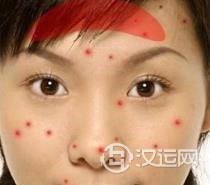 痘痘告诉你哪里生病了，脸上长痘痘怎么调理