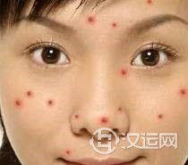 痘痘告诉你哪里生病了，脸上长痘痘怎么调理